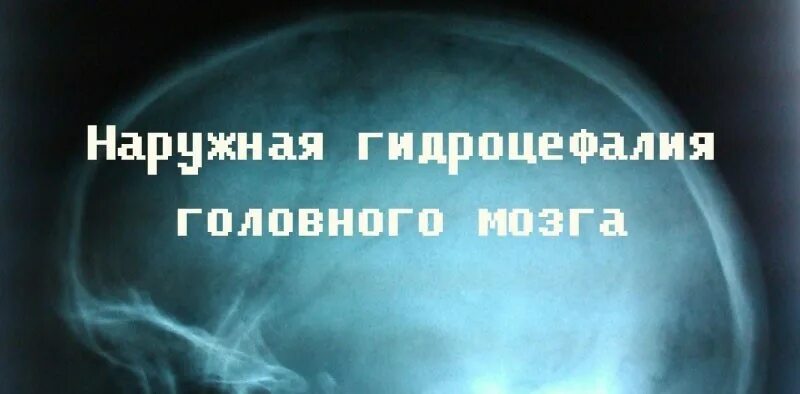 Наружная гидроцефалия головного мозга. Наружная заместительная гидроцефалия. Наружная заместительная гидроцефалия головного мозга. Наружная викарная гидроцефалия головного.