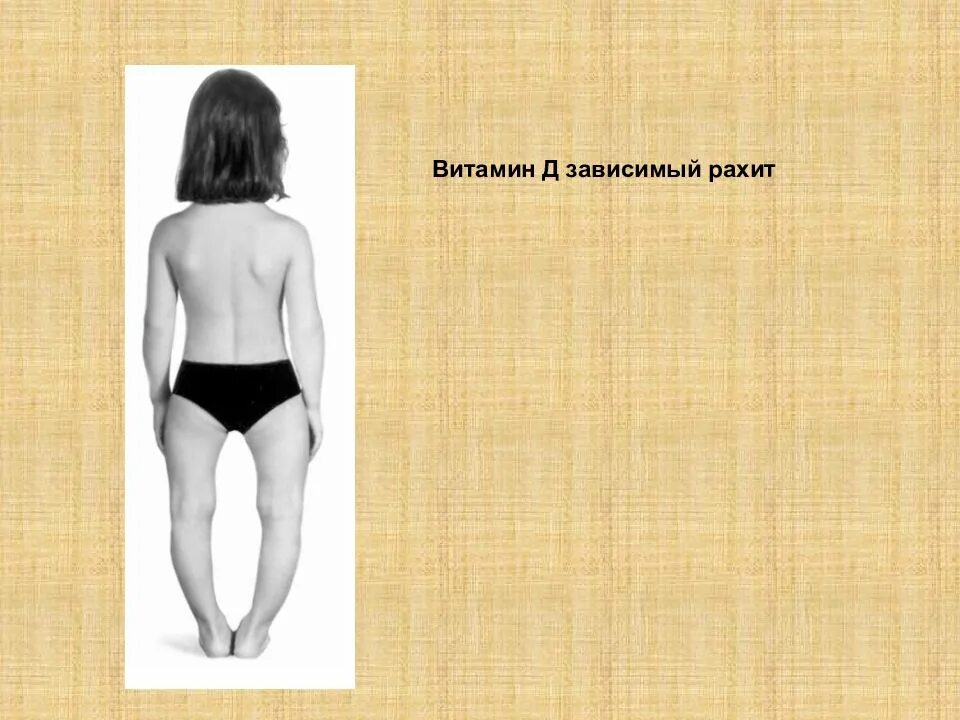 Наследование рахита. Х сцепленный доминантный тип наследования. Хондродистрофия, рахит. Х-сцепленный гипофосфатемический рахит. Наследование рахита.