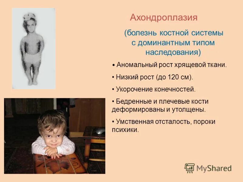 Рост генетических заболеваний. Рост генетических заболеваний. Рост генетических заболеваний. Синдром шерешевского тернера это наследственное заболевание. Рост генетических заболеваний.