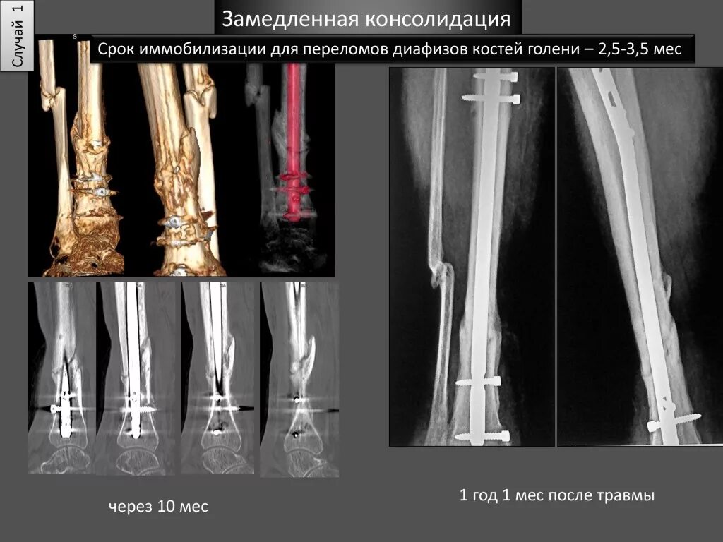 Что такое консолидация перелома. Этапы консолидации переломов костей рентген. Периостальная костная мозоль. Степень консолидации перелома рентген. Что такое неконсолидированный перелом большеберцовой кости.