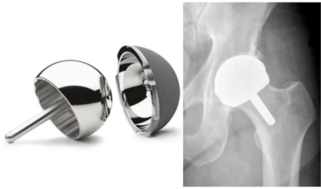 Эндопротез коленного сустава maxx orthopedics. Керамический эндопротез тазобедренного сустава. Замена сустава екатеринбург. Артроз коленного сустава. Артропластика тазобедренного сустава по фишкину.
