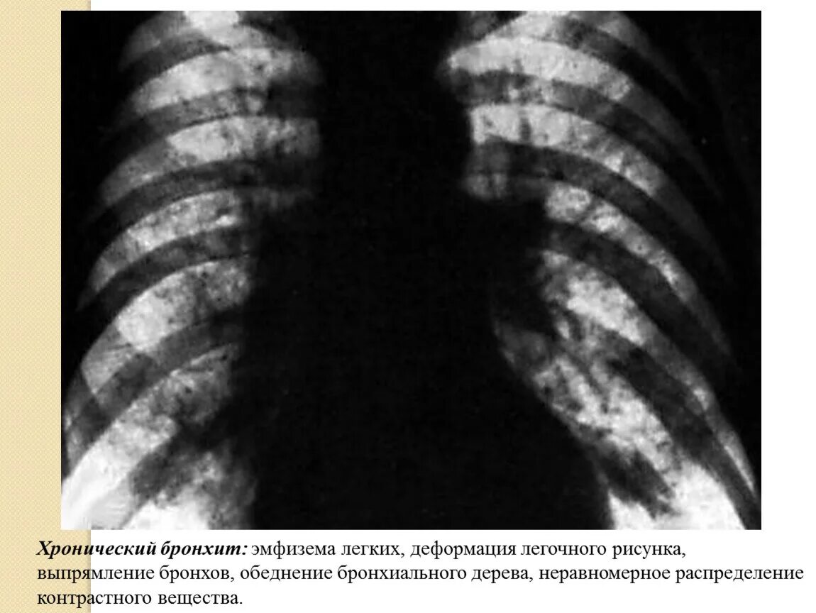 Эмфизема хронического бронхита. Пылевой бронхит рентгенограмма. Рентген хронический бронхит легких. Обструктивный бронхит рентгенограмма. Рентген снимки хронического бронхита.