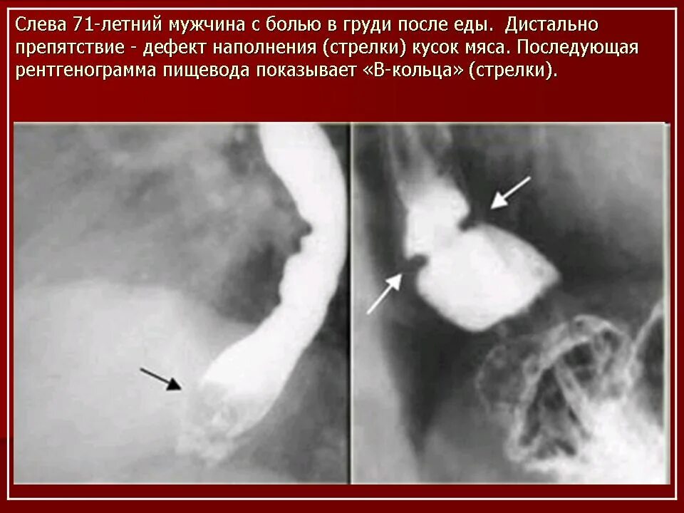 Пищевод шацкого. Пищевод Барретта рентген. Рентген при пищеводе Барретта. Дистальный эрозивный эзофагит. Рефлюкс пищевода рентген.