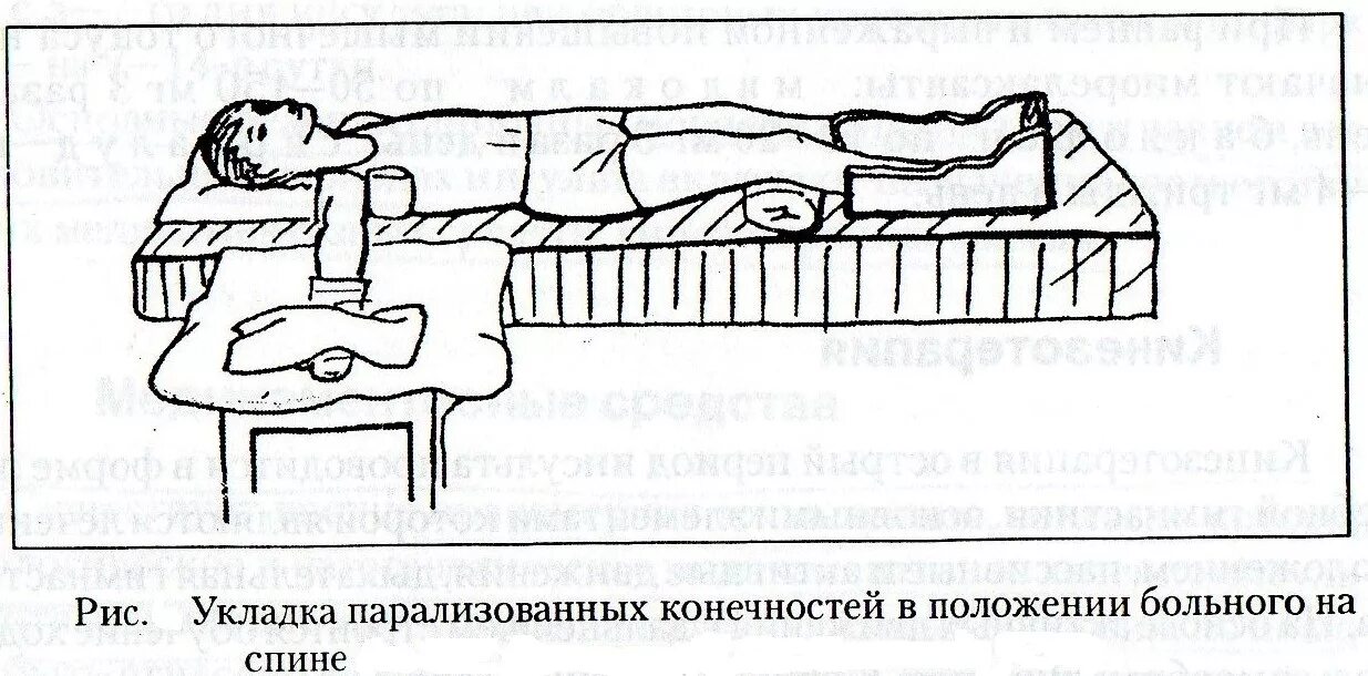 Парализовало левую сторону после инсульта. Правильная укладка парализованных конечностей. Укладка парализованных конечностей после инсульта. Положение больного после инсульта. Положение больного с инсультом.