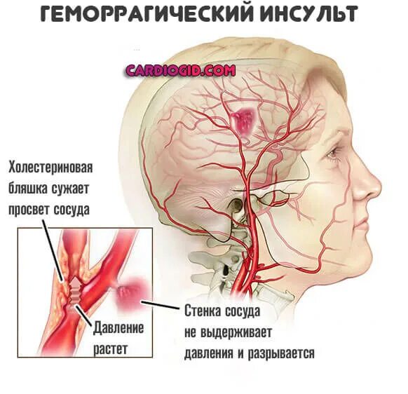 4 года инсульт. Клинические проявления геморрагического инсульта. Инсульт геморрагический разрыв сосуда и кровоизлияние. Ґоморрогический инсульт. Gemorragiki insult.