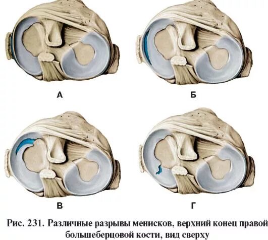 Дегенеративные изменения заднего рога медиального мениска 2. Классификация разрывов мениска Stoller. Разрыв заднего рога медиального мениска Stoller 2. Классификация повреждения менисков по Stoller. Повреждение медиального мениска 3 степени.