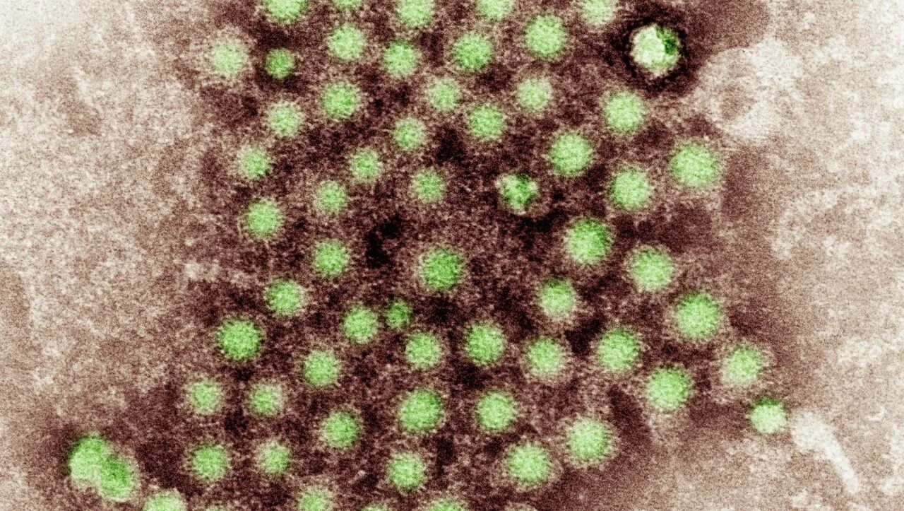 Вирус гриппа микрофотография. Электронная микрофотография вируса гриппа а. Вирус гепатита микрофотография. Вирус гепатита б под микроскопом. Заболевание грипп б