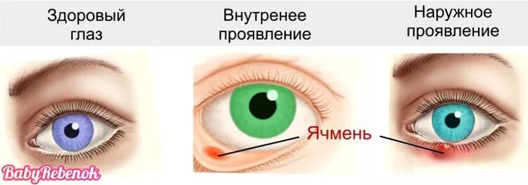 Лечение ячменя на нижнем. Заболевания век ячмень. Ячмень заболевание глаз.