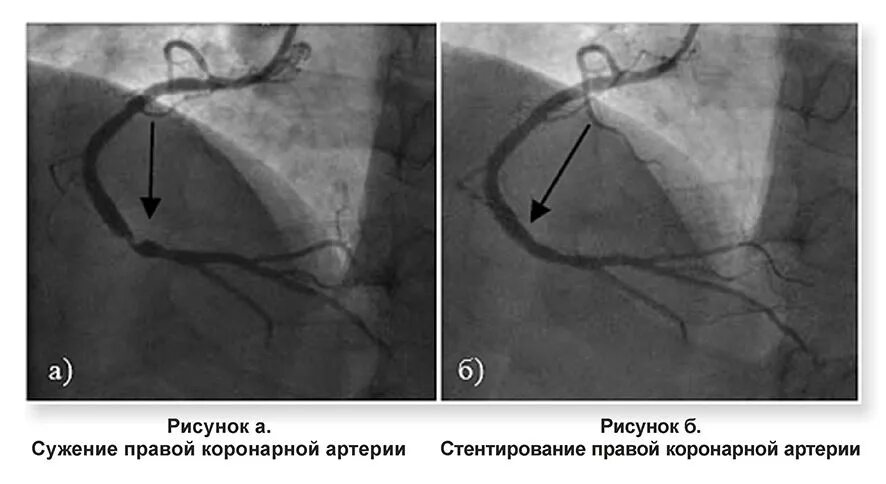 Сужение правой артерии. Коронарные артерии стеноз стент. Коронарография при инфаркте миокарда. Правая коронарная артерия ангиограмма. Коронарография стеноз ПМЖВ.