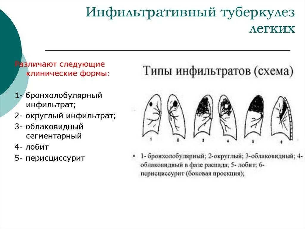 Инфильтрация является