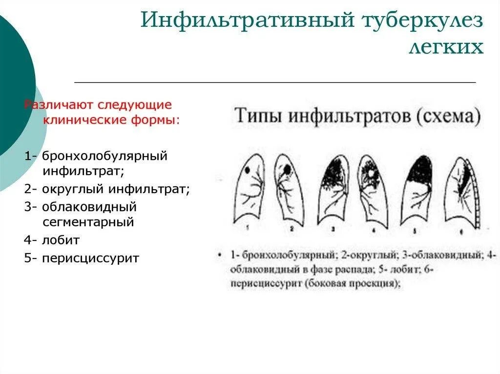 Фазы очагового туберкулеза