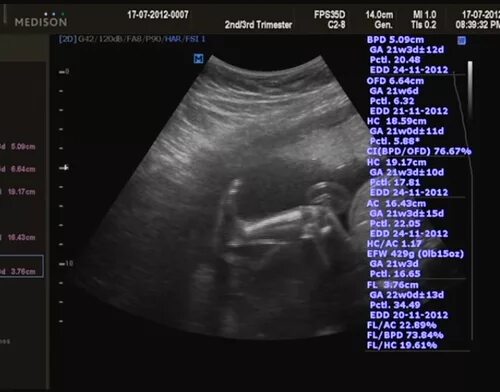 Показатели УЗИ на 22 недели. Ребенок на 22 неделе беременности фото.