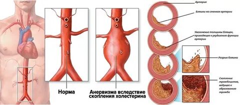 Атеросклероз створок клапанов