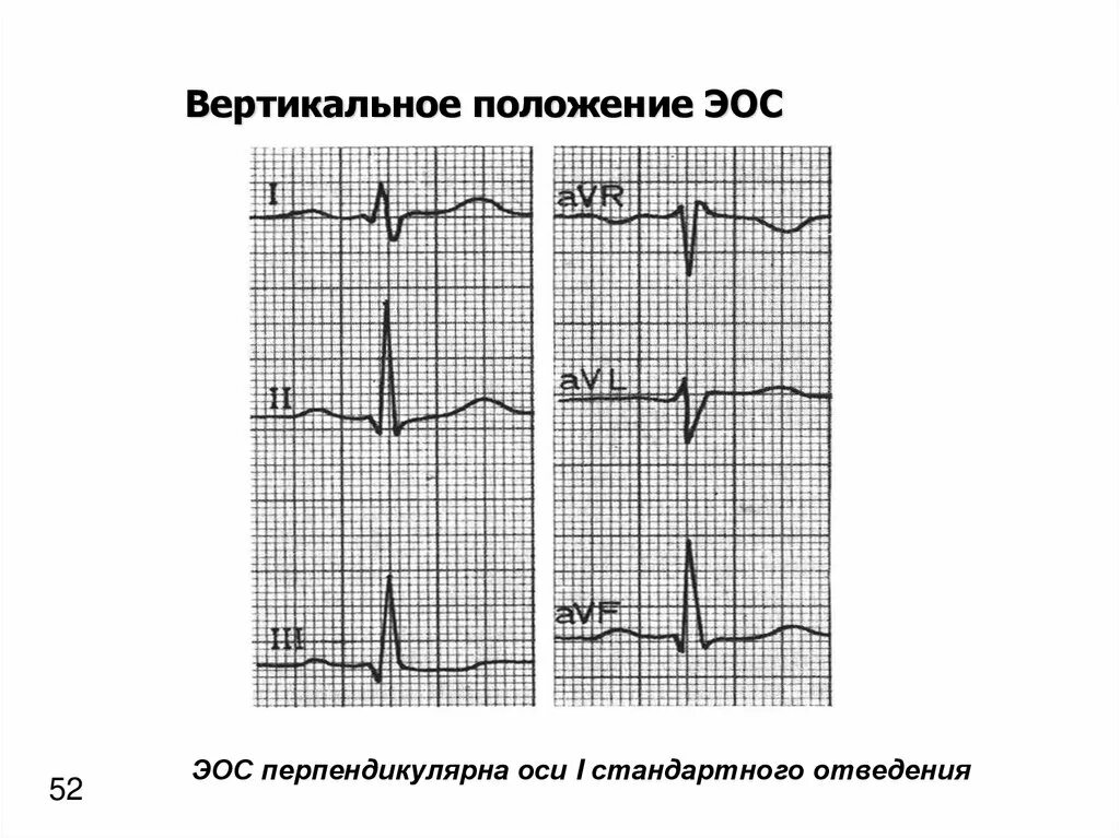Вертикальная позиция сердца. ЭКГ при вертикальном положении ЭОС. Вертикальное положение ЭОС на ЭКГ. Вертикальная ЭОС сердца на ЭКГ что это. ЭКГ электрическая ось вертикальная.