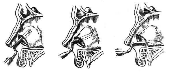 Подслизистая резекция носовой перегородки. Хирургическая отслойка слизистой оболочки носовой полости. Септопластика, подслизистая резекция носовой перегородки. Подслизистая резекция искривленной части перегородки. Операция по восстановлению перегородки