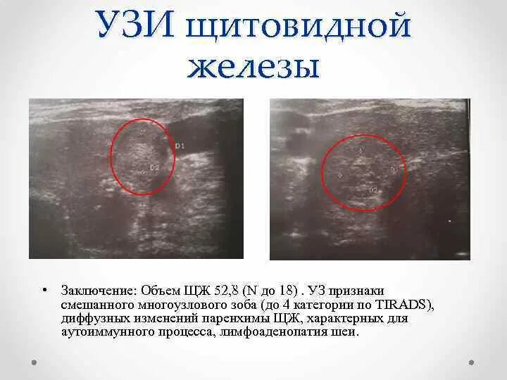 Диффузно узловой изменения. Уз-признаки аутоиммунного поражения железы. диффузные изменения пилонефрия. изменения диффузные щитовидной железы по типу булыжной мостовой. уз признаки что значит уз.