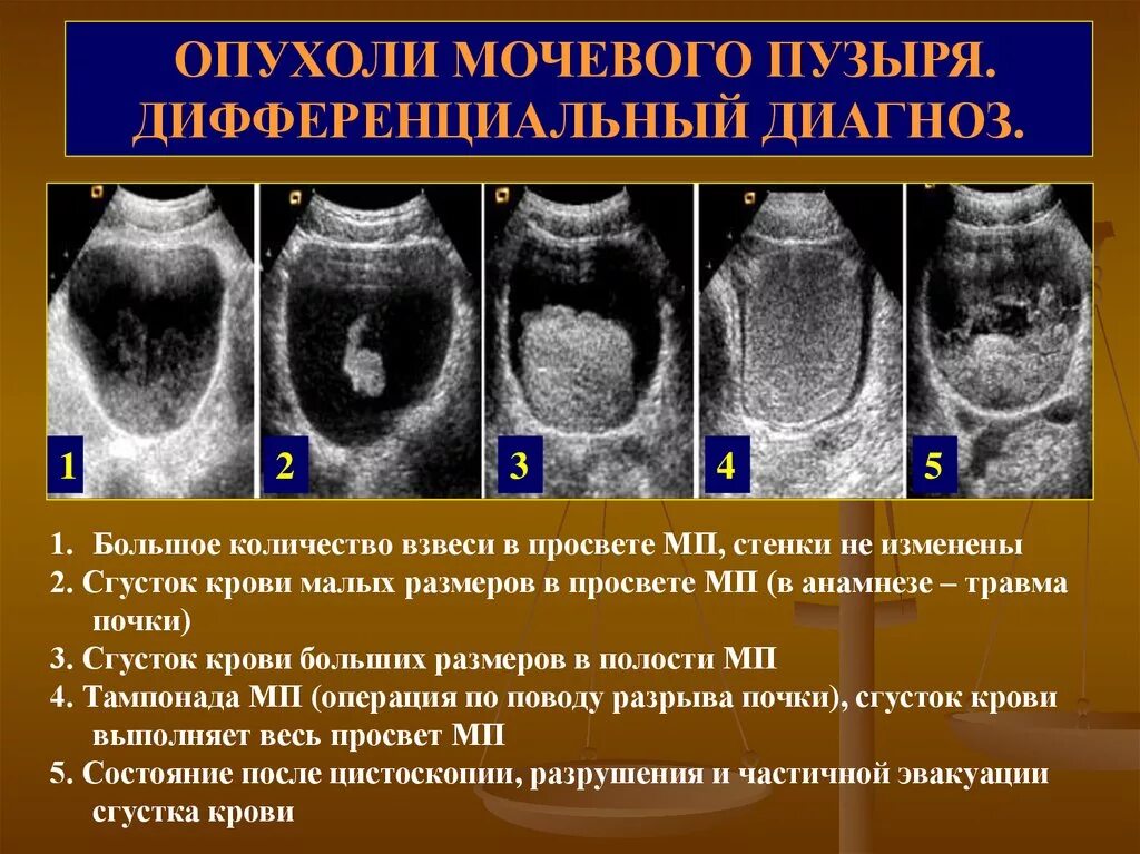 Опухоли мочевогоп пузыря. Объемное образование мочевого пузыря. Новообразование в мочевом. Доброкачественная опухоль мочевого пузыря. Распад органов