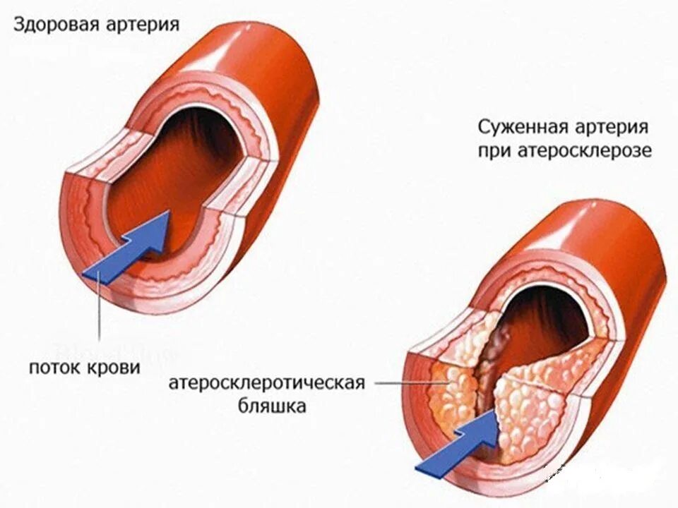 Выраженный атеросклероз. Атеросклеротическое сужение сосудов. сосуды при атеросклерозе. артерия при атеросклерозе.