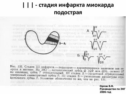 Инфаркт миокарда стадии