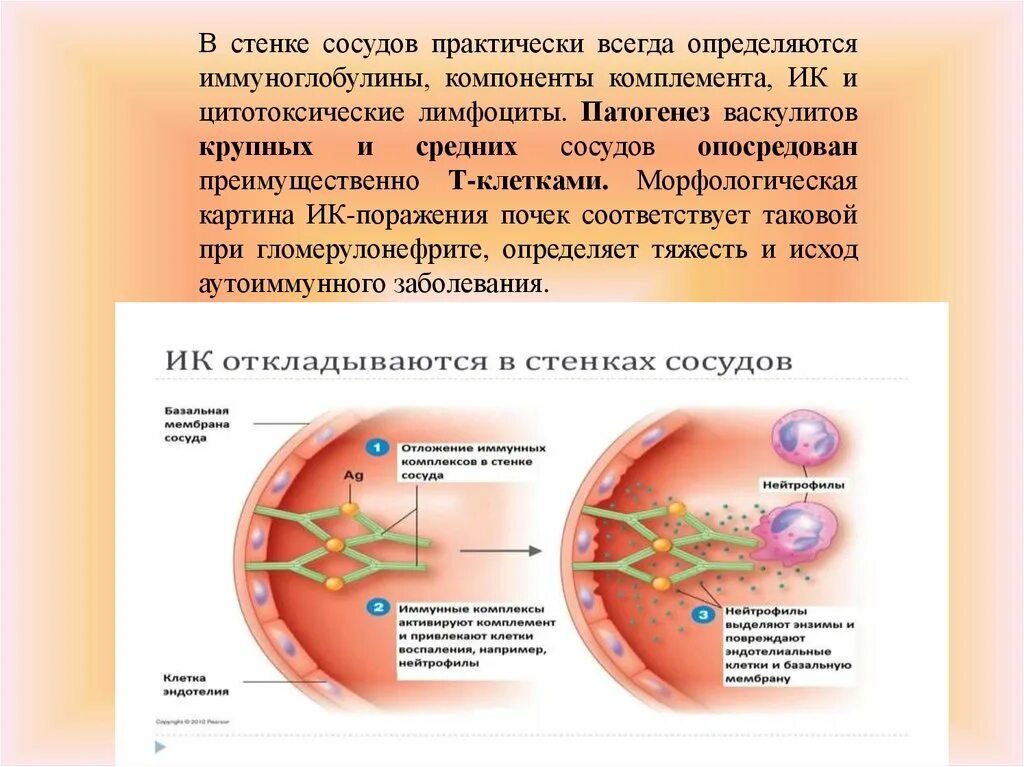 Системные васкулиты этиология. Васкулит механизм развития. Системные васкулиты патогенез. Геморрагический васкулит механизм развития. Васкулит патогенез