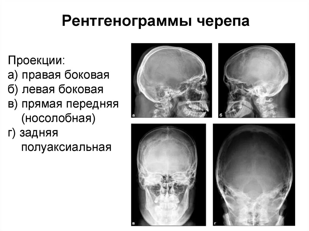 Аксиальная проекция рентген черепа. Рентген черепа боковая проекция правой. Рентген черепа тангенциальная проекция что это. Рентген черепа в боковой проекции норма. В правом черепе