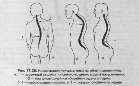 Физиологический изгиб позвоночника назад