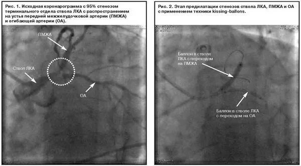 Процент стеноза сосудов. Коронарография стеноз ствола. Бифуркационный стеноз ствола лка это. Стеноз передней межжелудочковой артерии. Окклюзия ствола левой коронарной артерии.