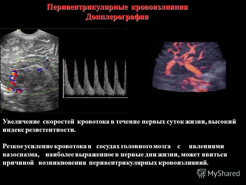 Индекс резистентности артерий. Допплерография. Допплерография сосудов головного мозга. Допплер артерий головного мозга. Транскраниальная допплерография норма.