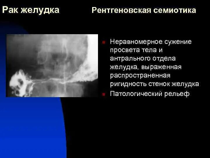 Рентгенологические признаки опухоли. Центральная опухоль легкого. Раковая опухоль рентген. Рентгенологические признаки опухоли. Уентральныйрак легкого.