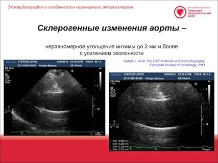 Диффузные изменения сердца