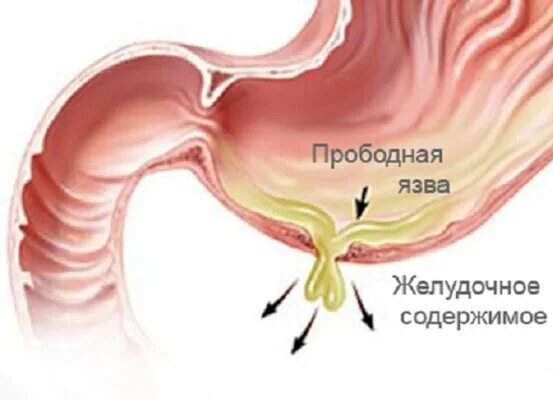 Прободение язвы желудка и Пенетрация. Язва желудка и 12 перстной кишки. Пенетрация 12 перстной кишки. Пенетрация язвенной болезни желудка и 12 перстной кишки.