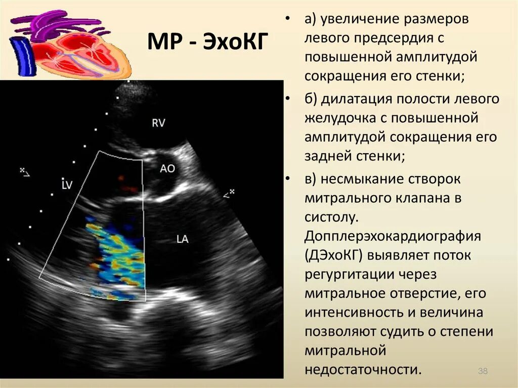 УЗИ ЭХОКГ порока сердца. Дилатация ЛП на ЭХОКГ. Фиброз створок митрального клапана УЗИ. Объем левого предсердия ЭХОКГ. Дилатация полостей предсердий