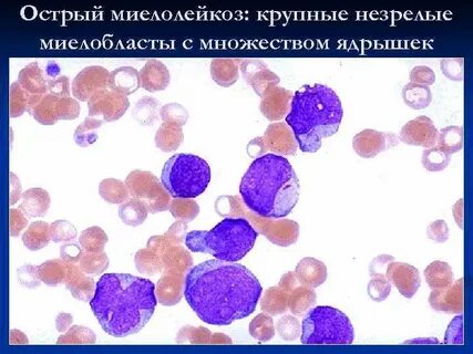 Острый моноцитарный лейкоз