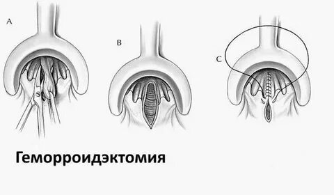 Сколько реабилитация после удаления геморроя