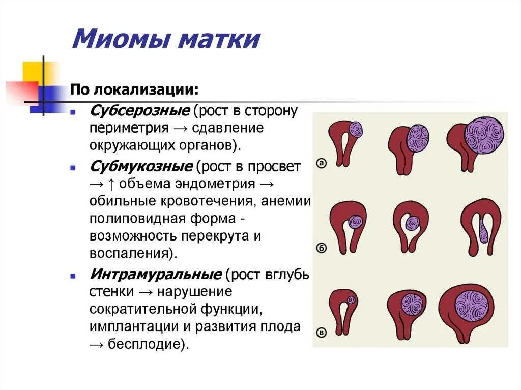 Миома матки симптомы и признаки. Миома матки классификация по размерам. Узловая миома матки 33мм. Типы роста миоматозных узлов. Шеечная локализация миомы.