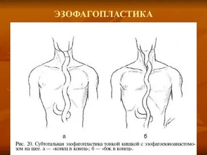 Пластика пищевода