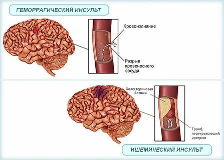 Вина инсульт