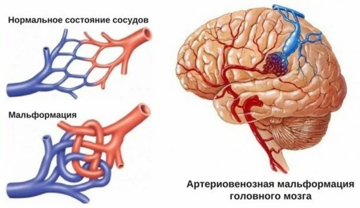 Сосудистая аномалия. АВМ мальформация сосудов головного мозга. Артеро венозная мальформация. Венозные мальформации головного мозга. Артериовенозная мальформация печени.