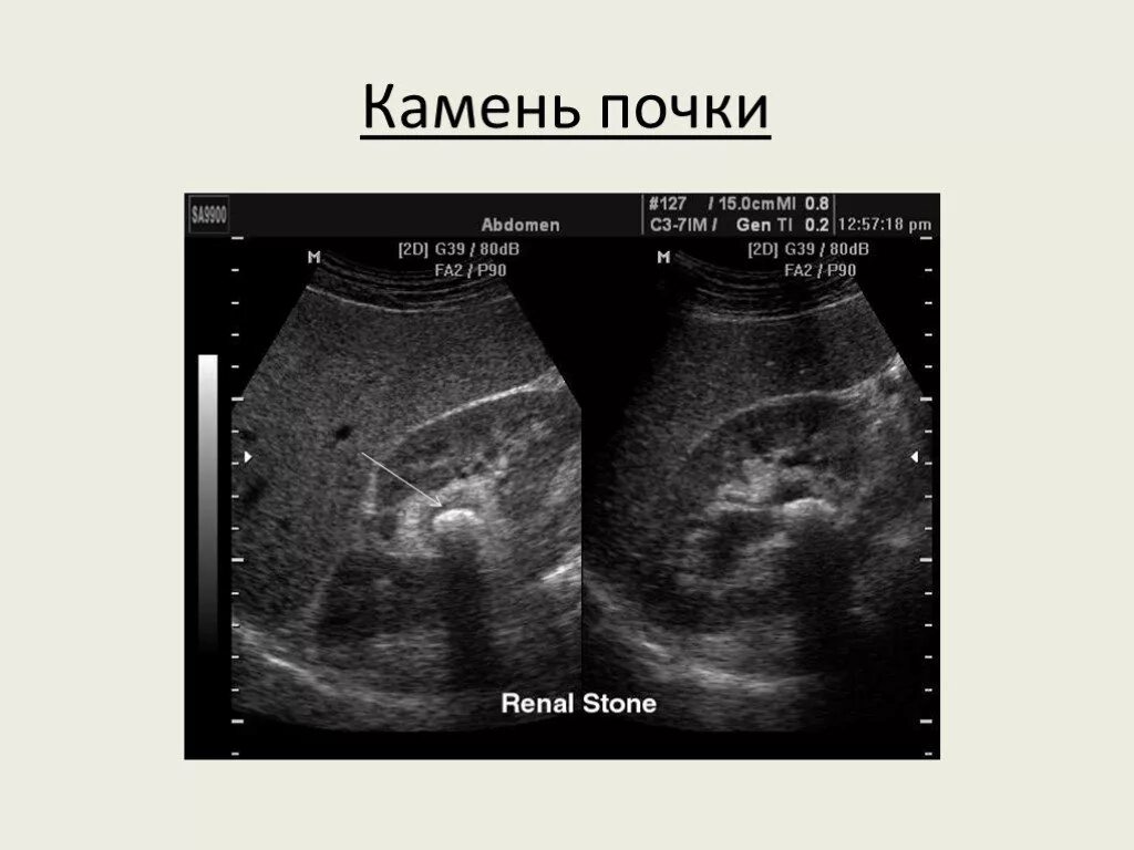 Камни в почках на узи фото Чрескожное удаление коралловидного камня почки