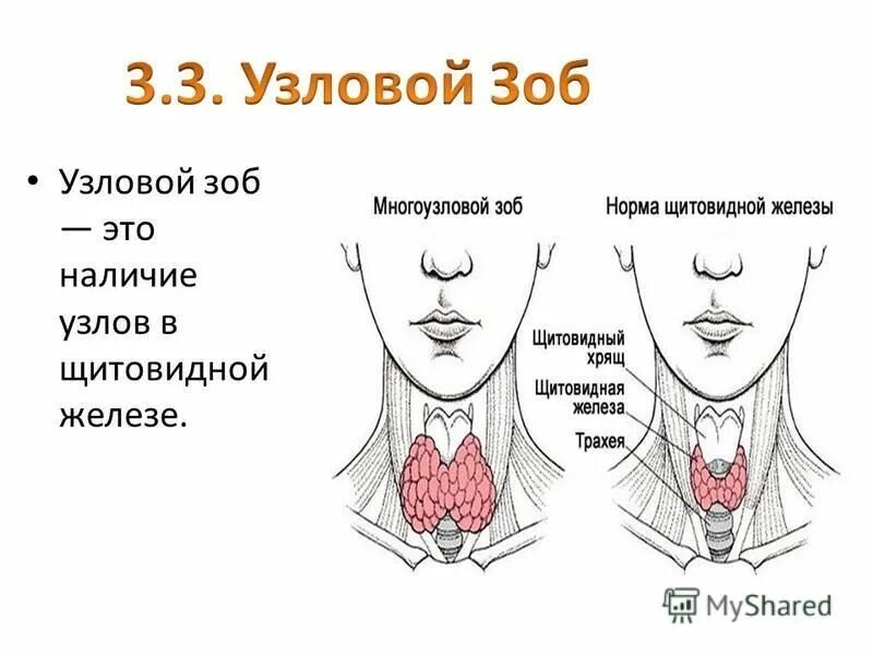 Жизнь после удаления щитовидной железы у женщин: последствия, операция и послеоп