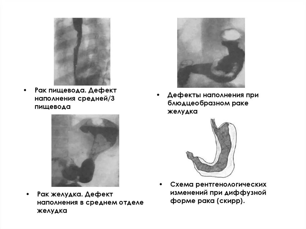 С г пищевода