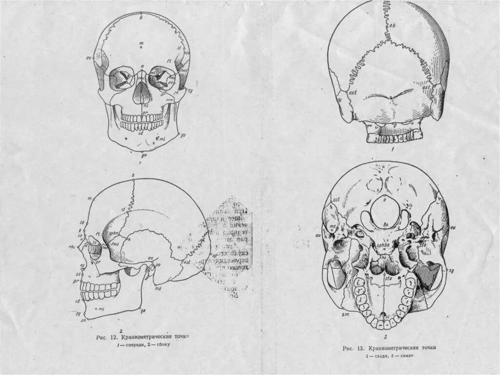 Черепная аномалия. Аномальные формы черепа. Патологические формы черепа.