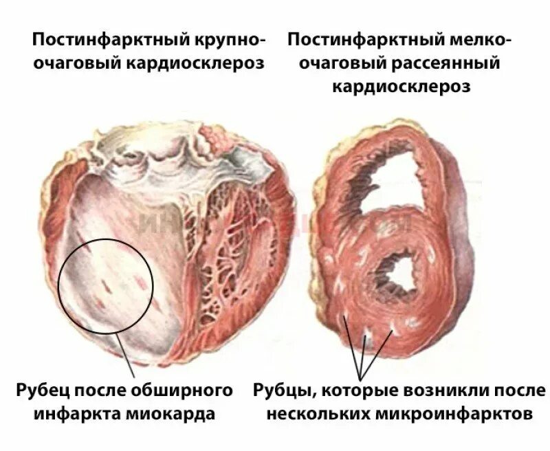 Осложнение на сердце после. Постинфарктный кардиосклероз рубец. Постинфарктный крупноочаговый кардиосклероз осложнения. Атеросклеротический кардиосклероз макропрепарат. Диагноз атеросклероз атеросклеротический кардиосклероз.