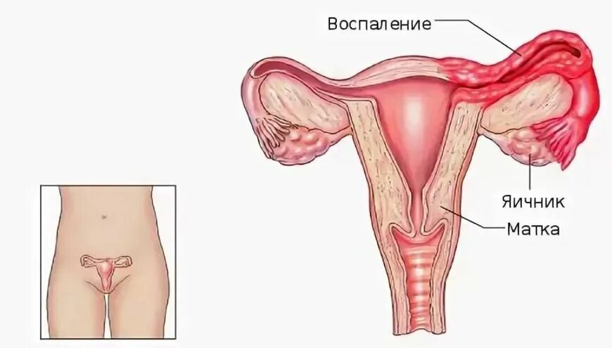 Воспаление матки у женщин симптомы и лечение. Послеродовый сальпингоофорит симптомы. Воспаление яичника и маточной трубы. Сальпингоофорит симптомы. Воспаление маточных труб.