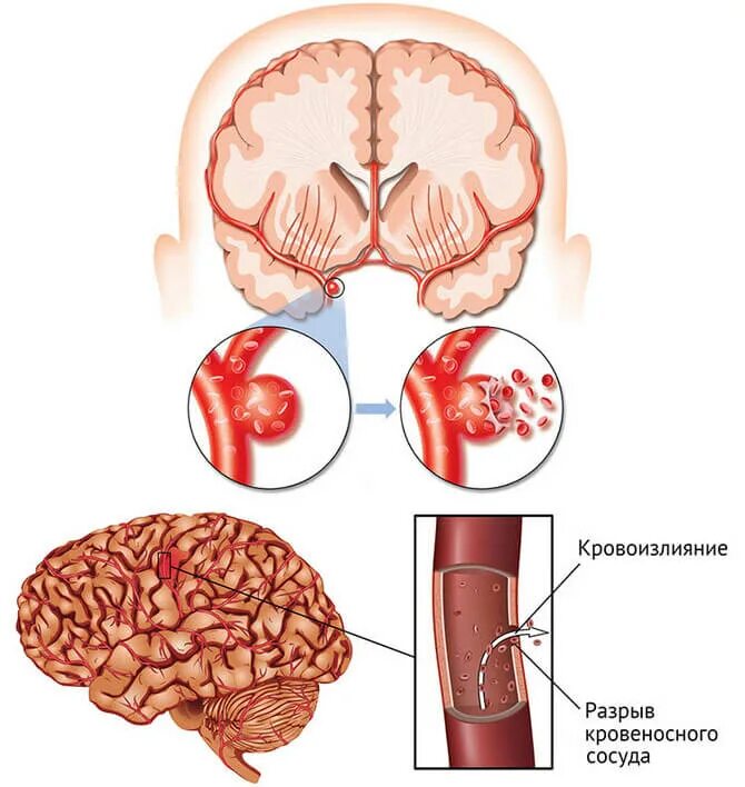 Инсульт после травмы. Внутримозговой геморрагический инсульт. Геморрагический инсульт это что такое геморрагический инсульт. Кортикальный геморрагический инсульт. ОНМК геморрагический инсульт.