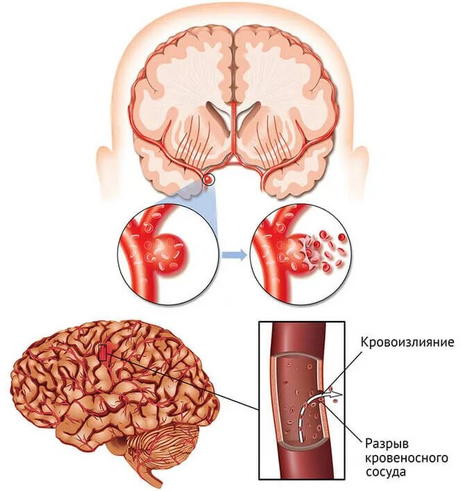 Внутримозговой геморрагический инсульт. Геморрагический инсульт это что такое геморрагический инсульт. Кортикальный геморрагический инсульт. ОНМК геморрагический инсульт. Был геморрагический инсульт