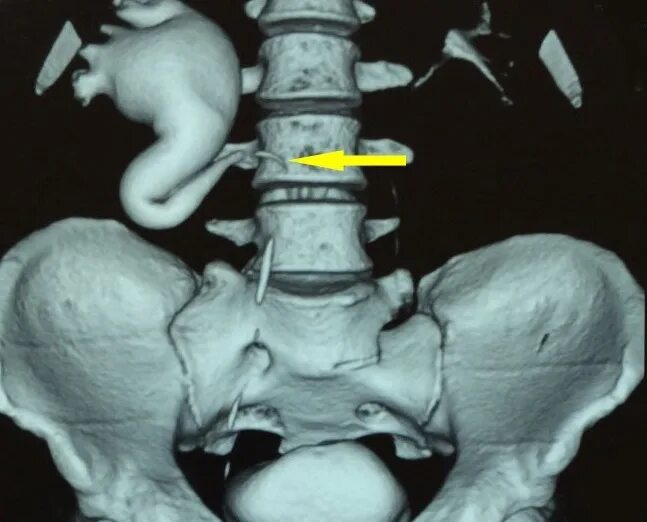 Перегиб мочеточника. Ретрокавальный мочеточник на рентгене. Мочеточник ретрокавальный на кт. Ретроилиакальный мочеточник. Ретрокавальное расположение мочеточника.