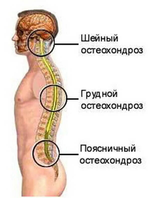 Спондилез поясничного отдела что симптомы и лечение. Остеохондроз шейный грудной поясничный. остеохондроз спондилез спондилоартроз. деформирующий спондилез l1-l3. спондилёз грудного отдела позвоночника что это такое.