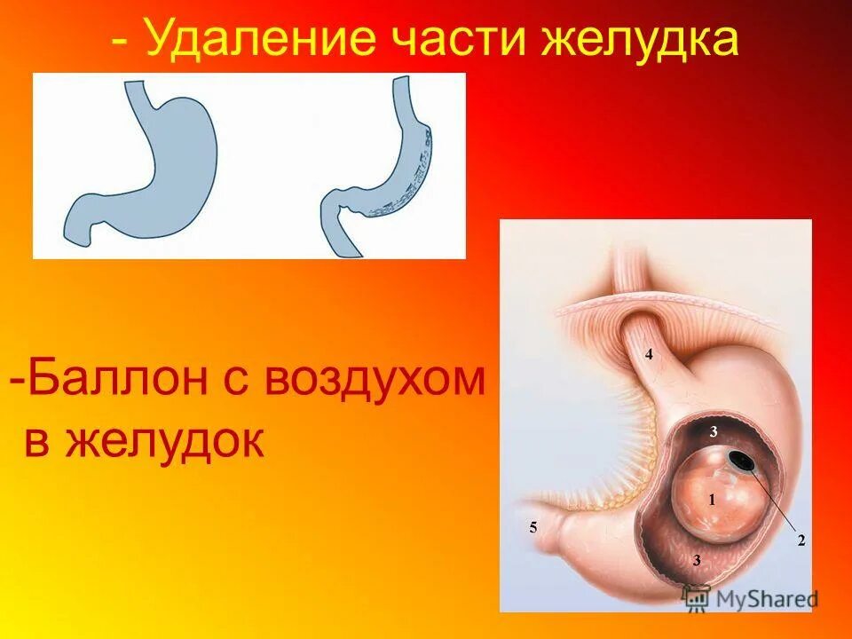Внутрижелудочный баллон. Операция внутрижелудочный баллон. Бариатрическая операция баллон. Операция внутрижелудочный баллон. Баллонирование желудка для похудения.