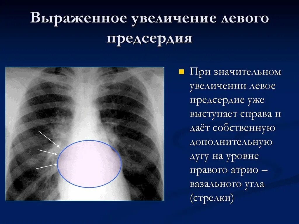 Левое предсердие увеличено